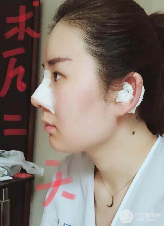 上海華美李庭勛膨體隆鼻前后對比圖一個月恢復心情日記