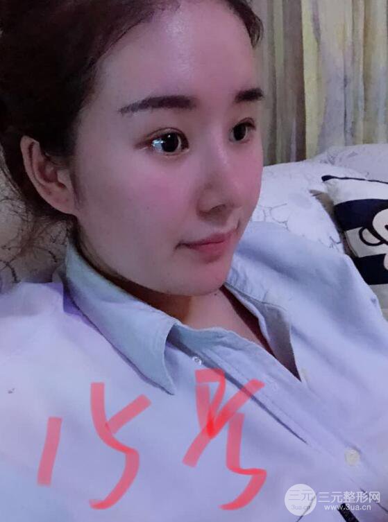 上海華美李庭勛膨體隆鼻前后對比圖一個月恢復心情日記