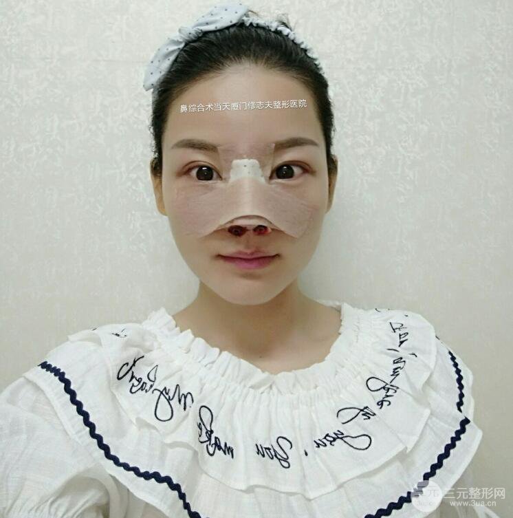 廈門修志夫隆鼻整形前后對(duì)比圖真人案例恢復(fù)小札