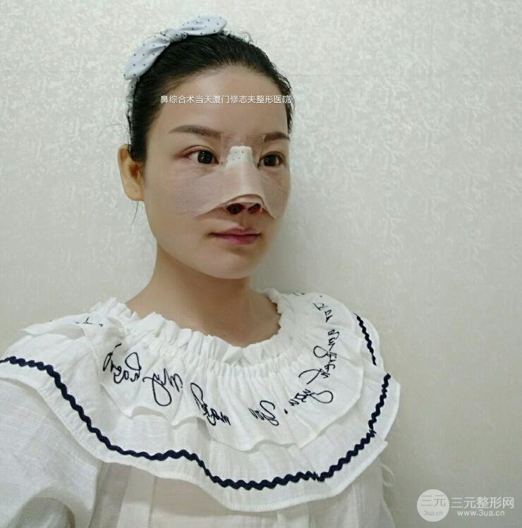廈門修志夫隆鼻整形前后對(duì)比圖真人案例恢復(fù)小札