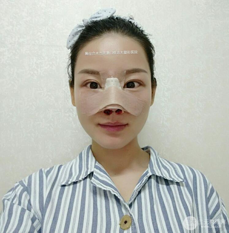 廈門修志夫隆鼻整形前后對(duì)比圖真人案例恢復(fù)小札
