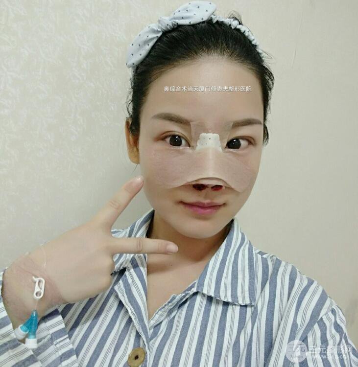 廈門修志夫隆鼻整形前后對(duì)比圖真人案例恢復(fù)小札