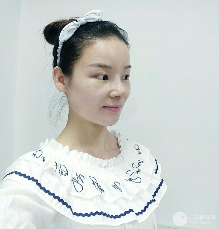 廈門修志夫隆鼻整形前后對(duì)比圖真人案例恢復(fù)小札