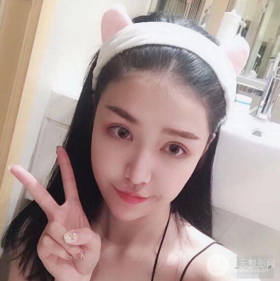 延吉金光善眼部整形失敗修復前后對比圖 三個月恢復自然