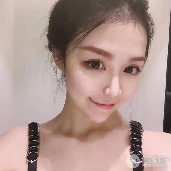延吉金光善眼部整形失敗修復前后對比圖 三個月恢復自然