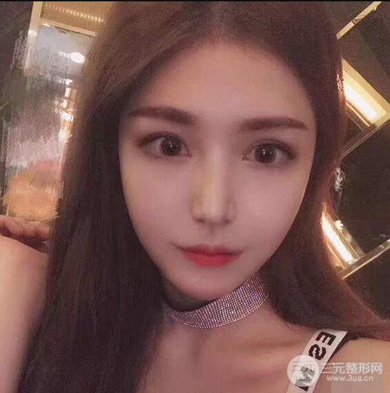 延吉金光善眼部整形失敗修復前后對比圖 三個月恢復自然