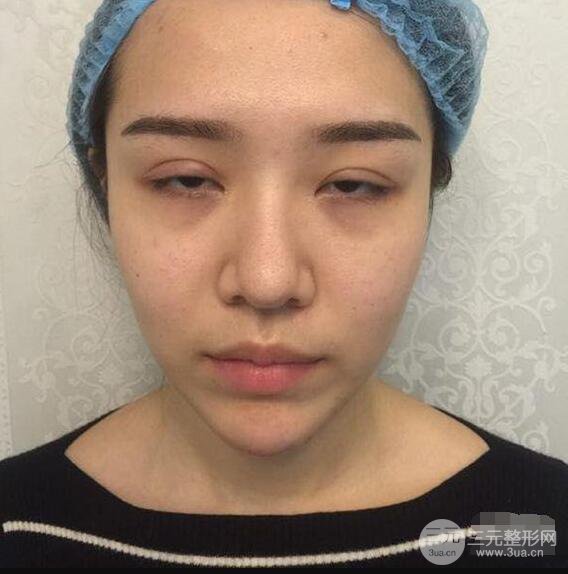 延吉金光善眼部整形失敗修復前后對比圖 三個月恢復自然