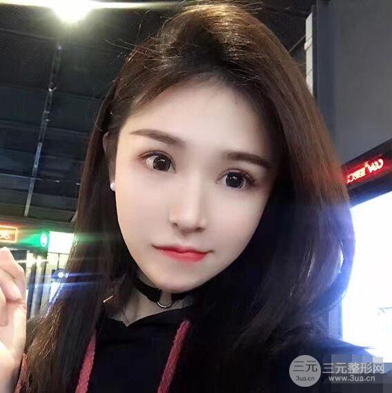 延吉金光善眼部整形失敗修復前后對比圖 三個月恢復自然