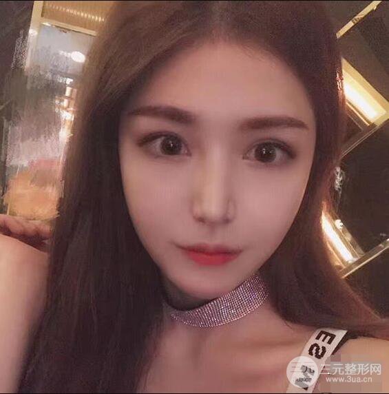 延吉金光善眼部整形失敗修復前后對比圖 三個月恢復自然