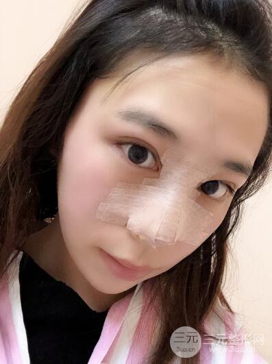 貴陽麗都李觀龍隆鼻整形案例對照圖一個月恢復過程分享