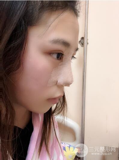 貴陽麗都李觀龍隆鼻整形案例對照圖一個月恢復過程分享