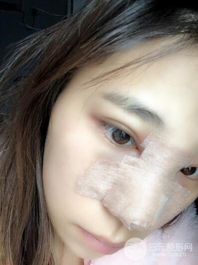 貴陽麗都李觀龍隆鼻整形案例對照圖一個月恢復過程分享