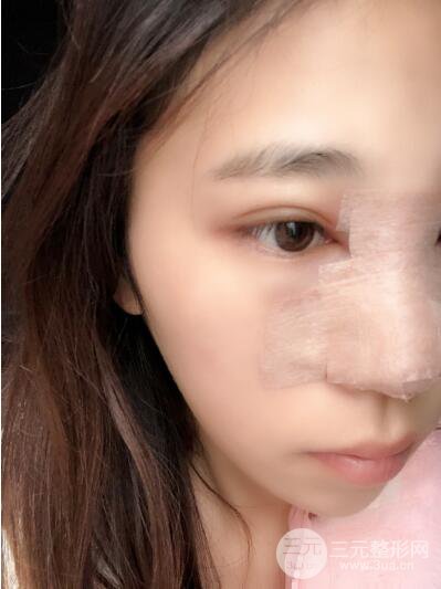貴陽麗都李觀龍隆鼻整形案例對照圖一個月恢復過程分享