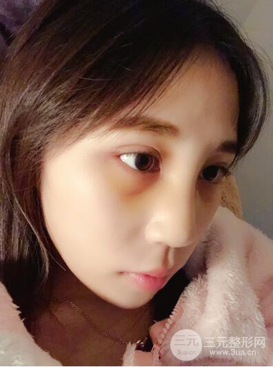 貴陽麗都李觀龍隆鼻整形案例對照圖一個月恢復過程分享