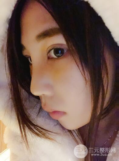 貴陽麗都李觀龍隆鼻整形案例對照圖一個月恢復過程分享