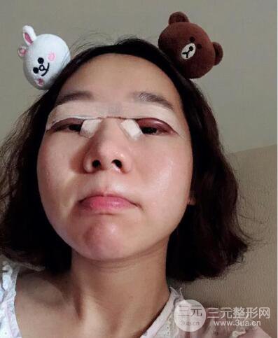 湘潭華美切開雙眼皮案例對(duì)照?qǐng)D兩個(gè)月恢復(fù)過(guò)程心情日扎