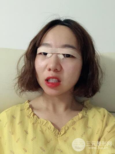 湘潭華美切開雙眼皮案例對(duì)照?qǐng)D兩個(gè)月恢復(fù)過(guò)程心情日扎