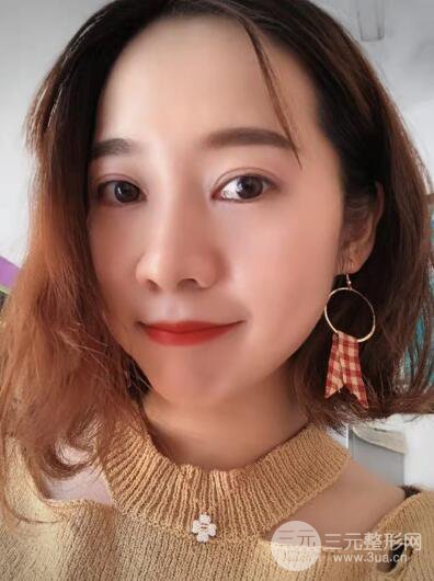 湘潭華美切開雙眼皮案例對(duì)照?qǐng)D兩個(gè)月恢復(fù)過(guò)程心情日扎