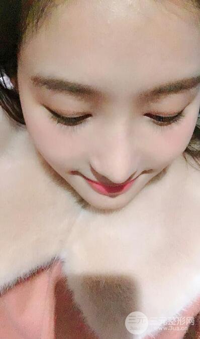 蘇州紫馨孫影塌鼻子假體隆鼻案例對比照心情小札