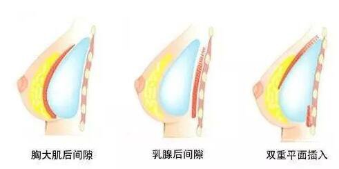 隆胸之后可以坐飛機嗎？