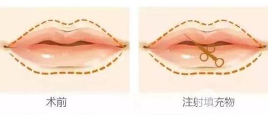 玻尿酸豐唇整形手術(shù)要多少錢？價格影響在于？