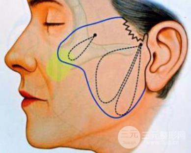 懸吊除皺術(shù)可以做幾次?美膚果持久嗎？
