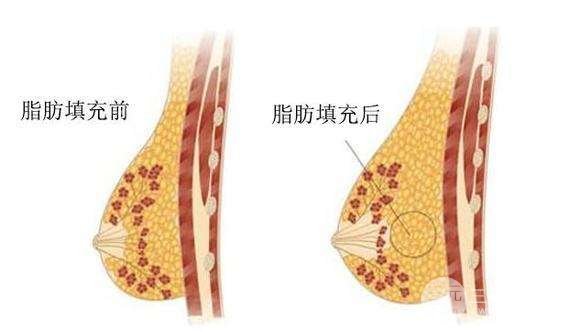 自體細(xì)胞豐胸