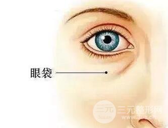 內切祛眼袋