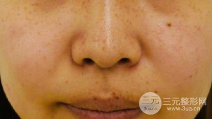 誰(shuí)做過(guò)彩光嫩膚有果嗎