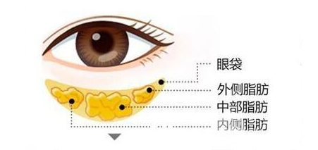 眼袋抽脂術(shù)的原理及果