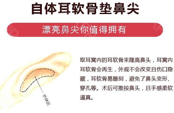 上海自體耳軟骨隆鼻價格多少錢？