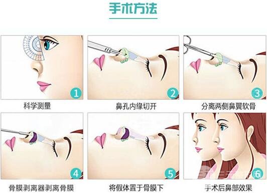 曼特波隆鼻降低風(fēng)險嗎 手術(shù)原理