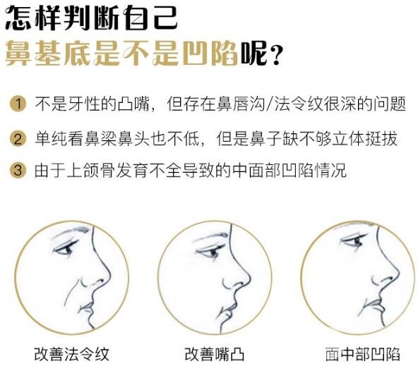 假體墊鼻基底多少錢？貴不貴