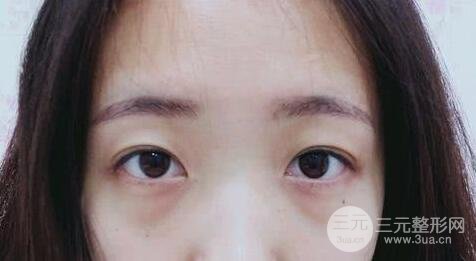 外切去眼袋手術果，會留疤嗎？