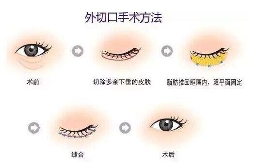 外切去眼袋手術果怎么樣?