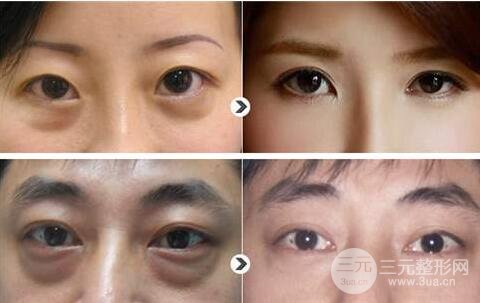外切去眼袋手術案例