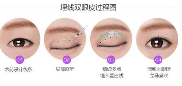 埋線雙眼皮的費(fèi)用