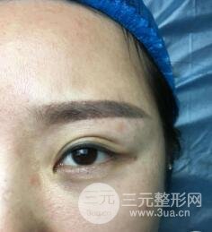 埋線雙眼皮后的注意事項(xiàng)