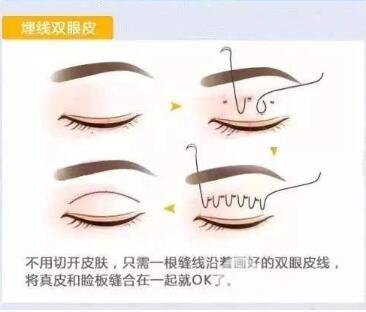埋線雙眼皮手術法
