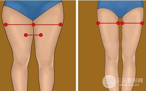 吸脂瘦大腿腫脹期是多久？多久能看到果？