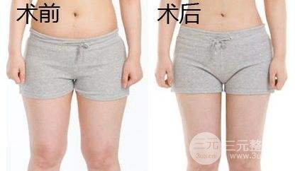 吸脂瘦大腿腫脹期是多久？多久能看到果？