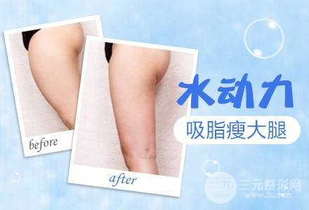 吸脂瘦大腿腫脹期是多久？多久能看到果？