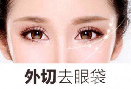 外切去眼袋多久恢復自然？看完你就懂了~
