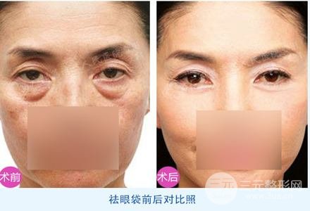 外切去眼袋多久恢復自然？看完你就懂了~