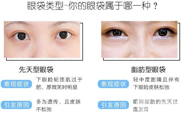 激光去眼袋多少錢？貴嗎？別讓你的眼袋越變越大！