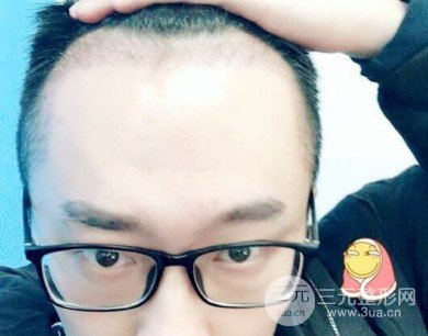 為什么植發(fā)設在這兩個科室