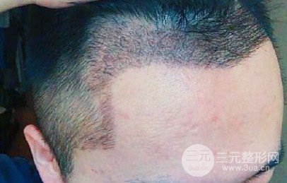 醫(yī)院主流植發(fā)技術