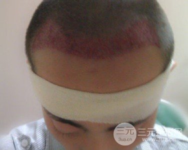 ?？谌嗣襻t(yī)院可以植發(fā)嗎