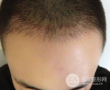 ?？谌嗣襻t(yī)院可以植發(fā)嗎