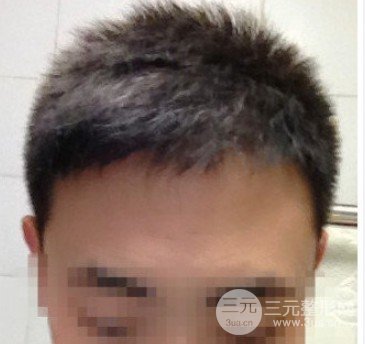 ?？谌嗣襻t(yī)院可以植發(fā)嗎